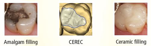 Cerec