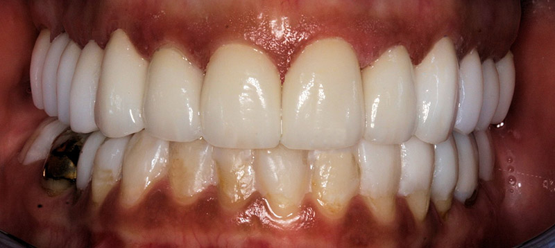 Upper Porcelain Restorations for TMD and Headache Relief After