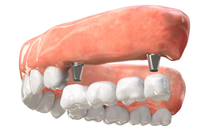 Implant Bridge