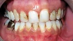Upper Porcelain Restorations for TMD and Headache Relief Before