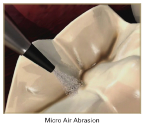 Air Abrasion