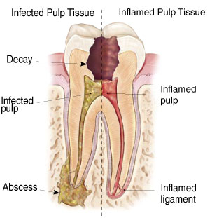 Inside of an infected tooth