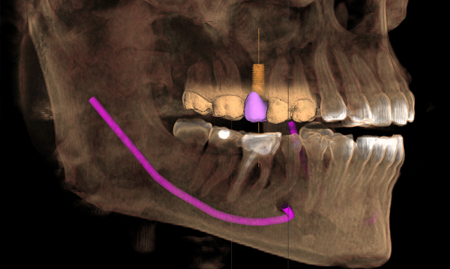 pi-galileos-implant-rendering-646