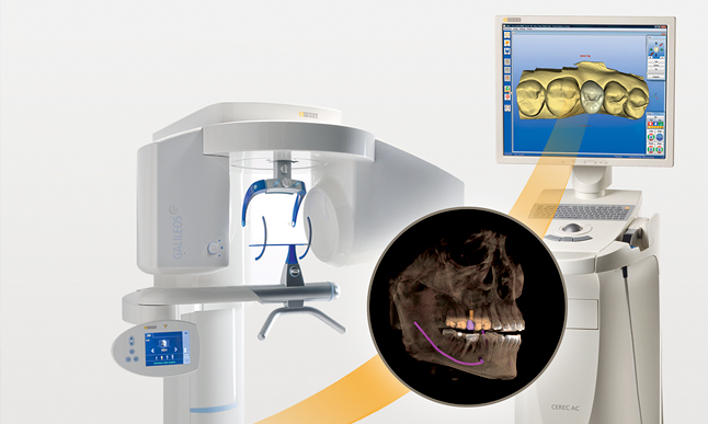 Galileous CEREC Implant