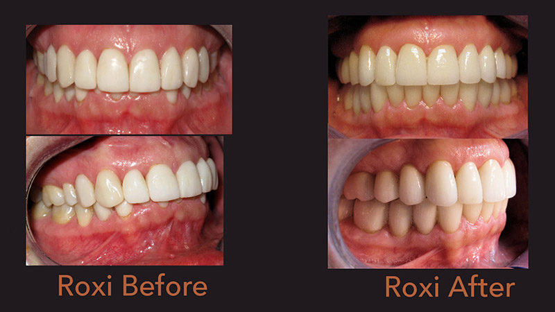 Roxi: Full Mouth Rehabilitation for TMD Before