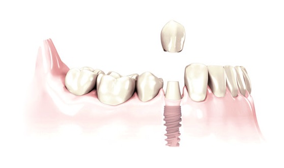 Single Tooth Replaced by an Implant