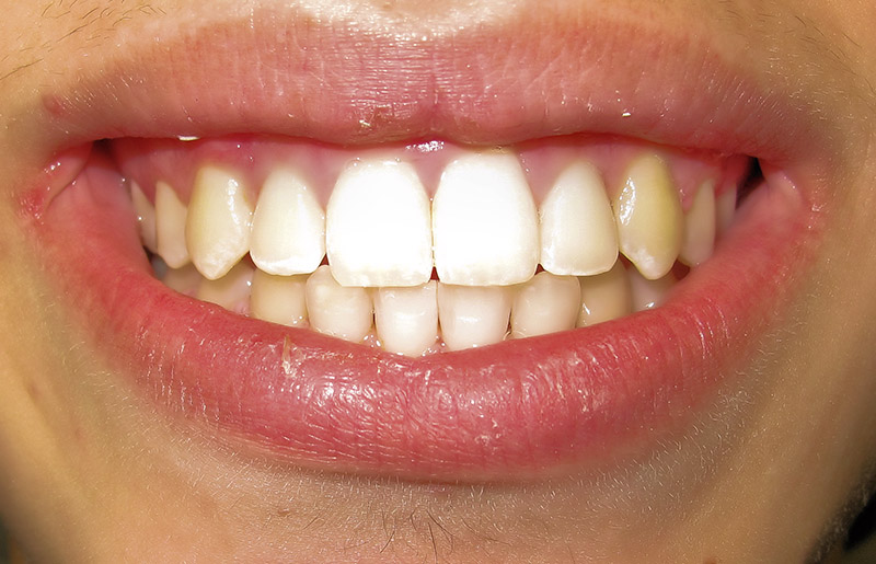 Skylan: Braces after expansion and overbite correction After