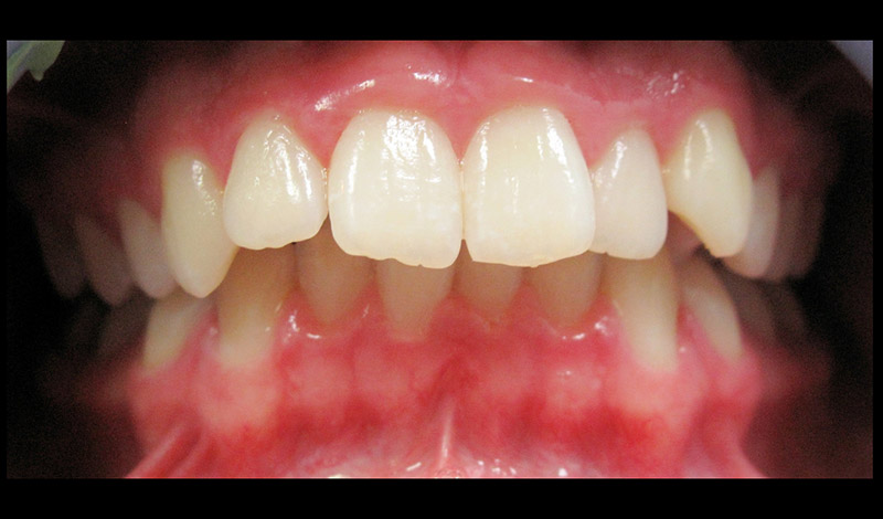 Skylan: Braces after expansion and overbite correction Before