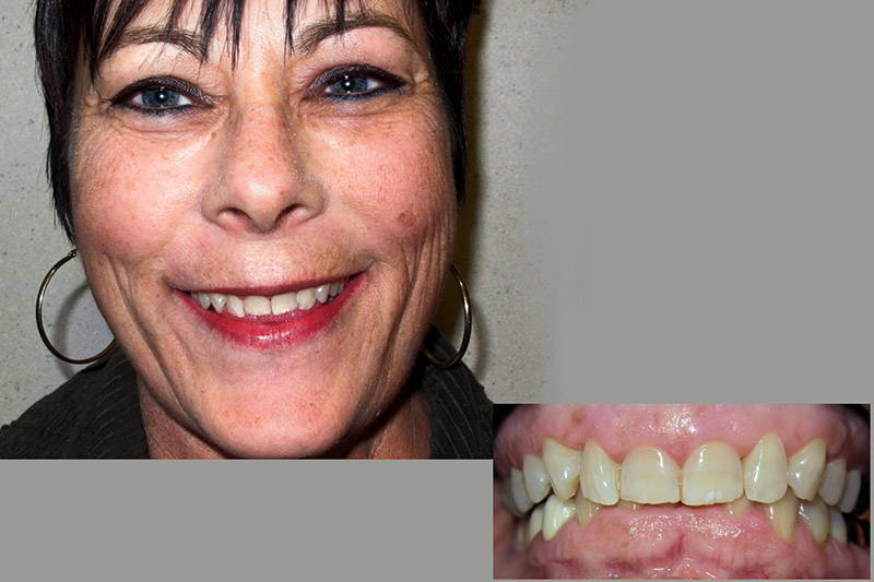 Sue : Full Mouth Rehabilitation for TMD Before