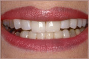 Veneers After